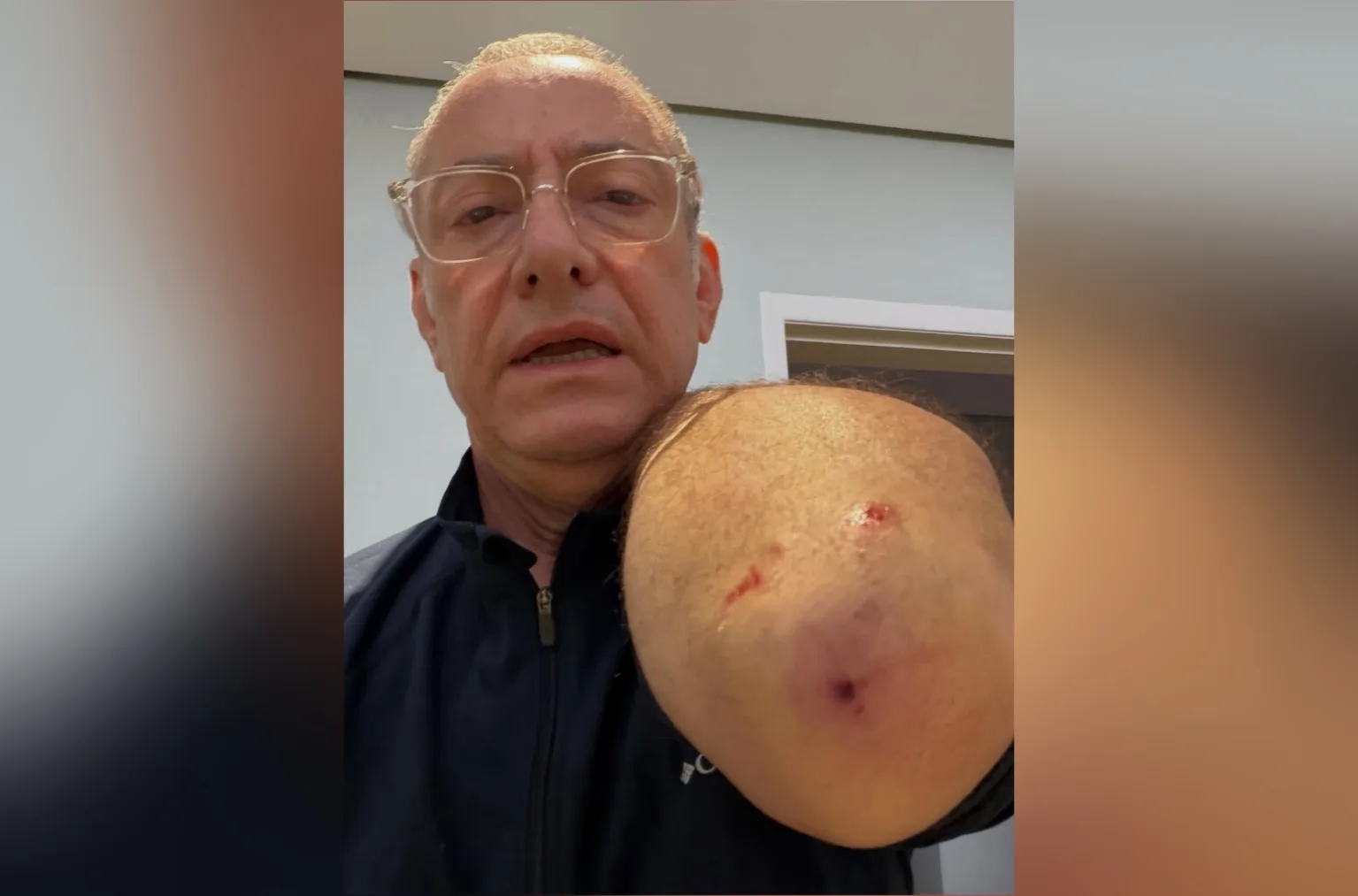 Burnier recebe alta após ataque de pitbull e faz alerta sobre responsabilidade dos tutores; veja vídeo