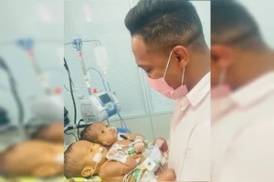 Gêmeos siameses morrem dias antes de cirurgia de separação; veja vídeo