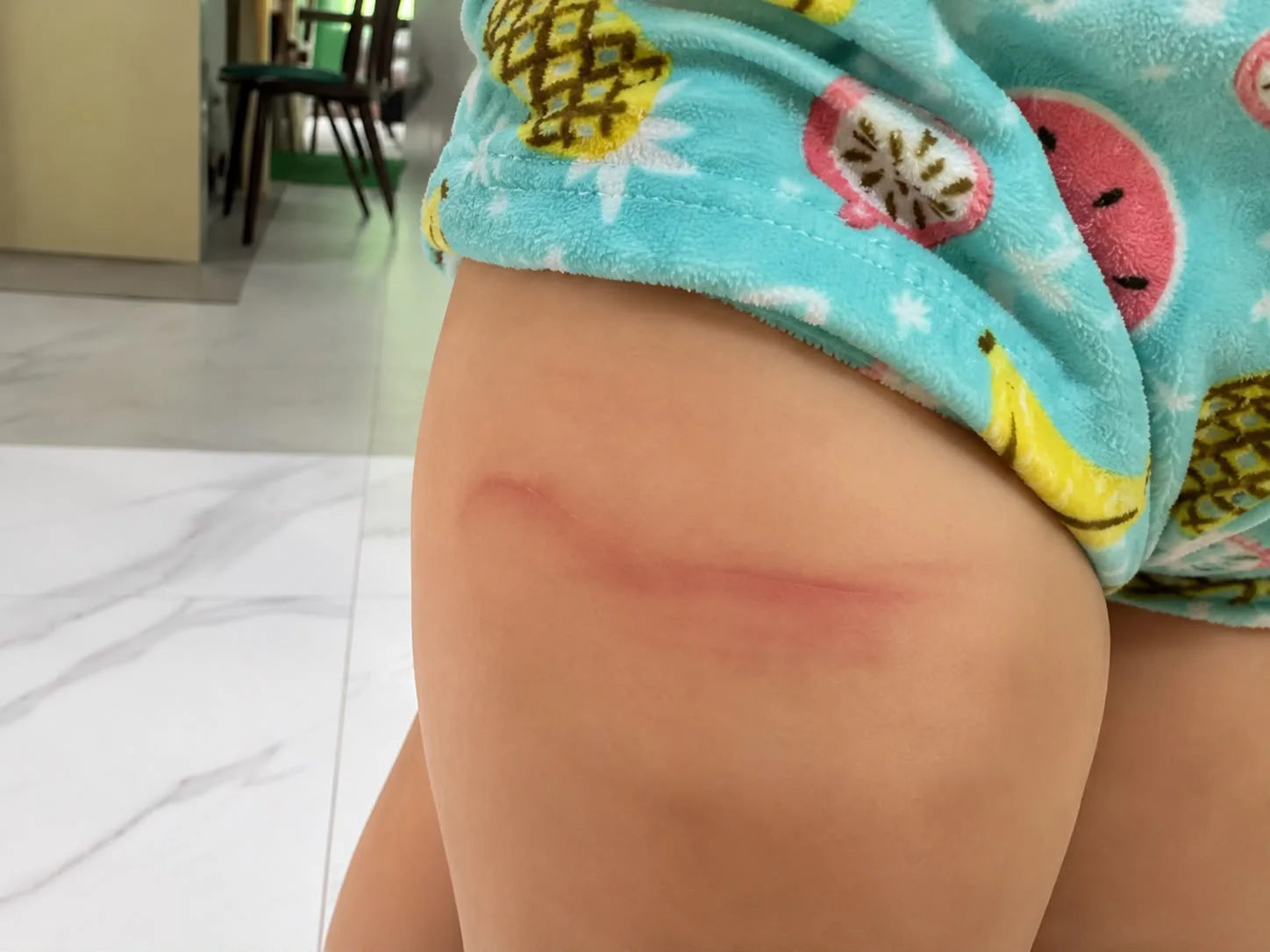 criança de 4 anos aparece com hematomas e denúncia de agressão explode; Veja vídeo